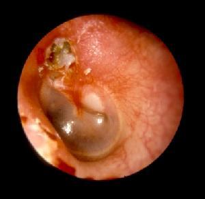 中耳炎有哪些危害，严重吗？