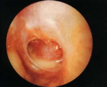 中耳乳突炎有什么危害?
