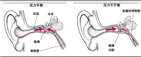 郑州急性外耳道炎的治疗