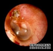 化脓性中耳炎有哪些危害