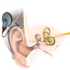 两台人工耳蜗手术在我院成功实施