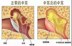 患上中耳炎怎么办？